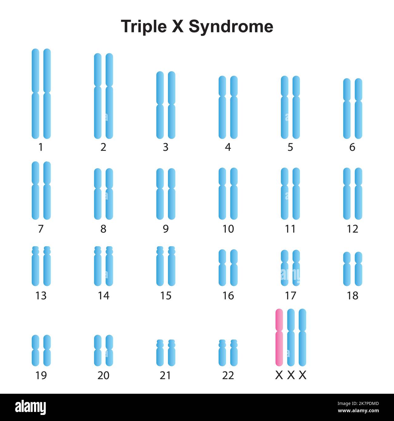 Diseño científico del cariotipo del Síndrome de Triple X (Trisomía X ...