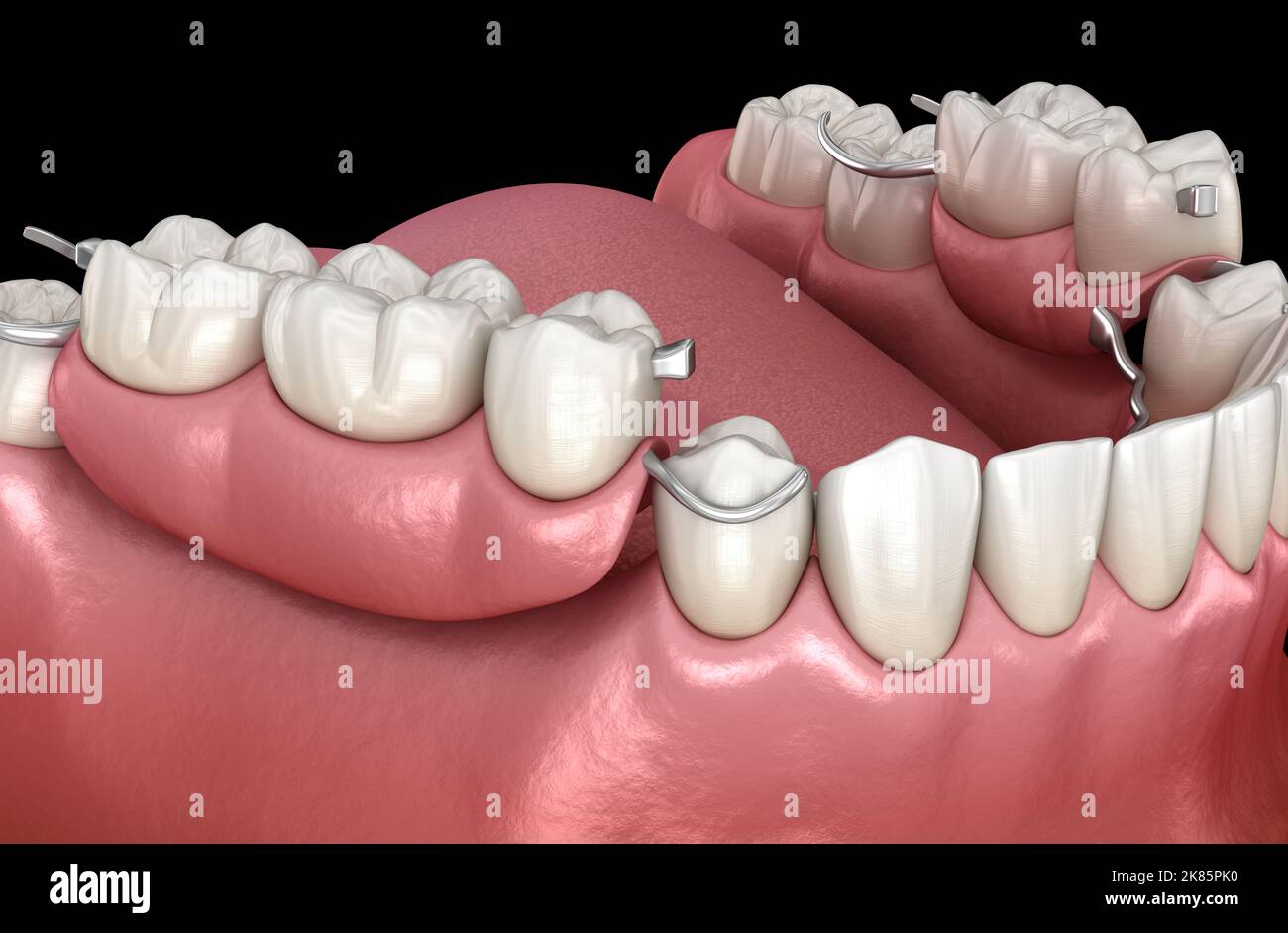 Dentadura parcial removible, prótesis mandibular. Ilustración