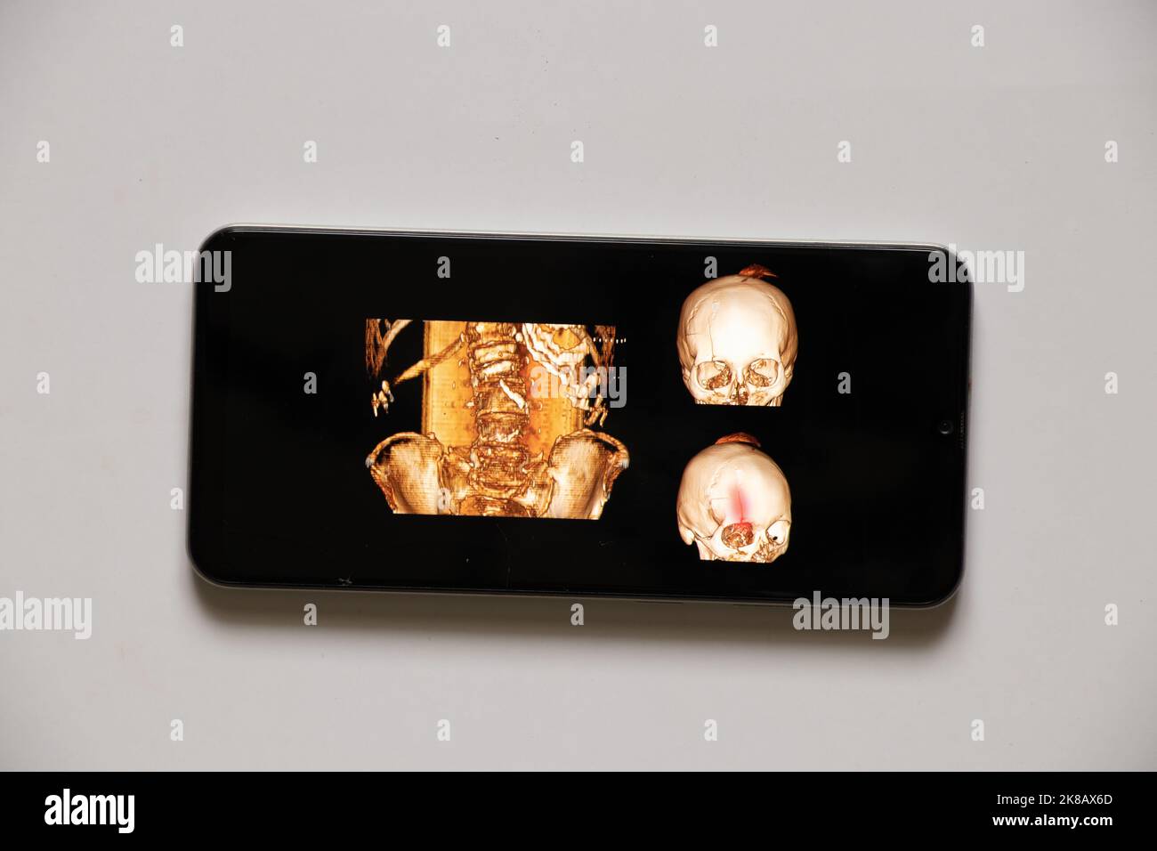 tomografía computada de la columna vertebral de un anciano con osteochandrosis con vértebras fracturadas y su desplazamiento y un cráneo con fractura por fractura Foto de stock