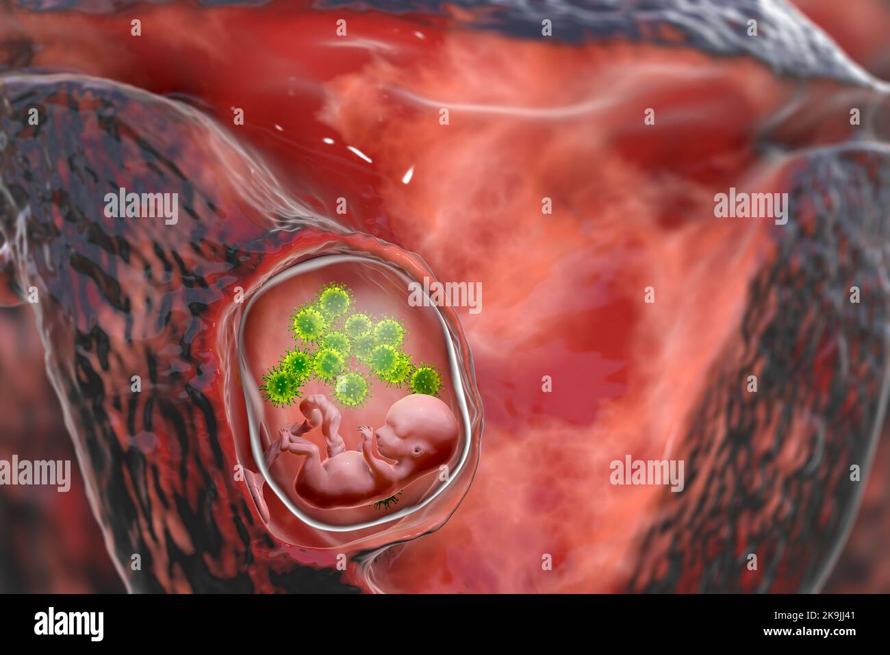 Citomegalovirus Congenita Fotografías E Imágenes De Alta Resolución Alamy 2186