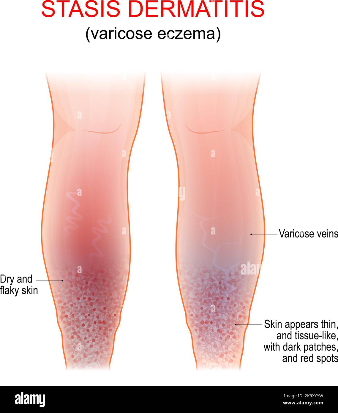 Eccema varicosa. Síntomas de dermatitis venosa, gravitacional o estasis. Afección prolongada de la piel que afecta la parte inferior de las piernas con venas varicosas Ilustración del Vector