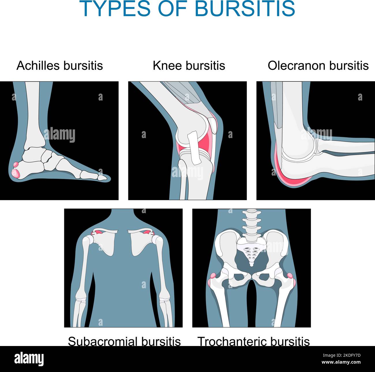 Tipos de bursitis. Inflamación de los sacos con líquido sinovial. Establecer iconos de articulaciones de rodilla, Aquiles, cadera, codo y hombro. Vector plano monocromo Ilustración del Vector