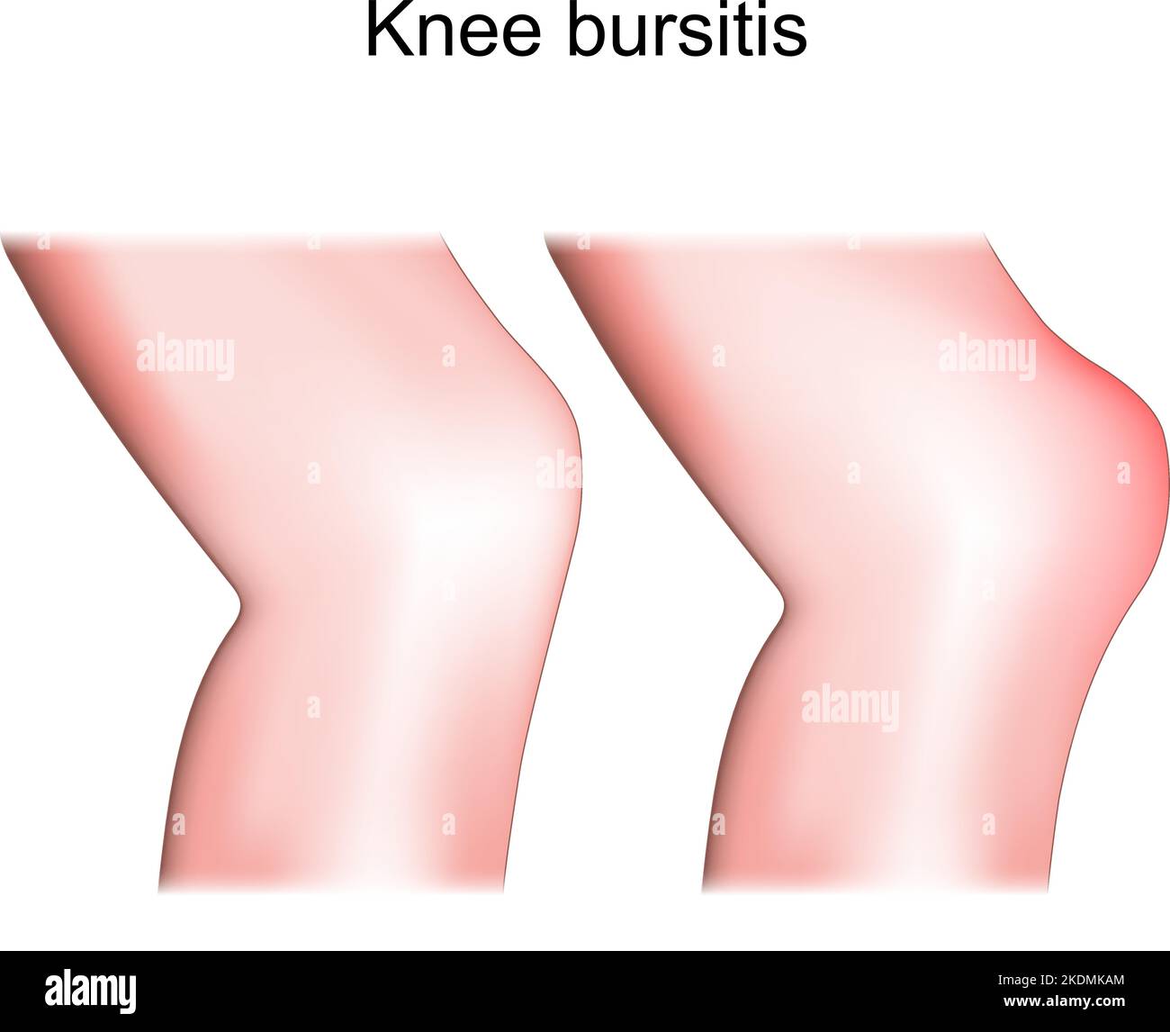 Bursitis de rodilla. Bursitis prepatelar Diferencia y comparación de la articulación sana y la inflamación de la rodilla. Vista lateral o lateral de la pierna humana. Vector Ilustración del Vector