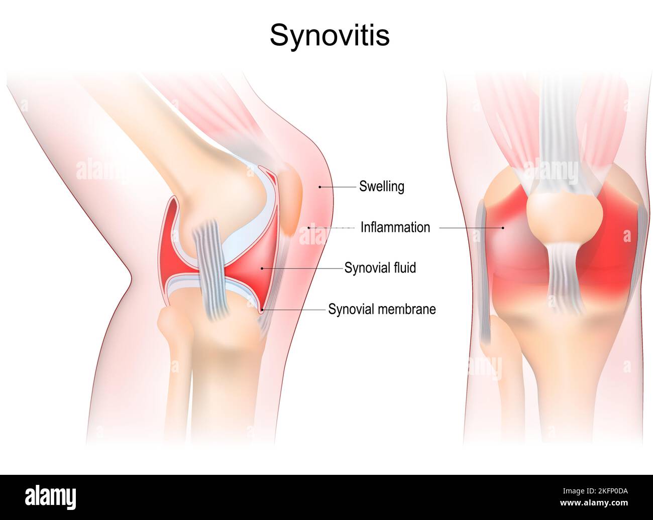 Sinovitis de una rodilla. Primer plano de la articulación con inflamación de la membrana sinovial. Signos y síntomas de la enfermedad. Anatomía de la articulación sinovial. Ilustración del Vector