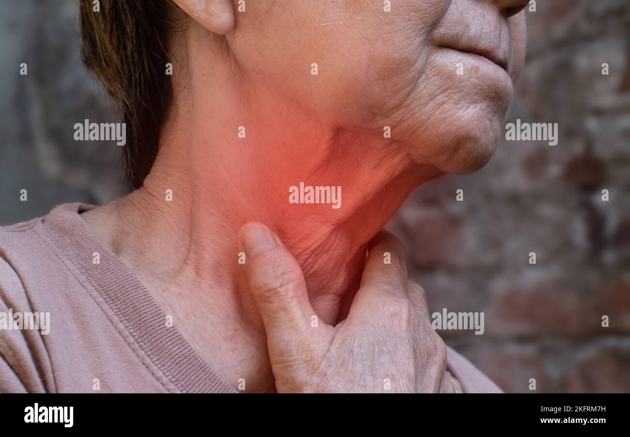 Enrojecimiento en el cuello de la mujer asiática de Myanmar. Concepto de dolor de garganta, faringitis, laringitis, tiroiditis o disfagia. Foto de stock