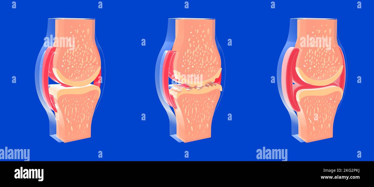 3D ilustración de la articulación sinovial y otras articulaciones con osteoartritis y artritis reumatoide. Representación gráfica de huesos, tendones. Foto de stock