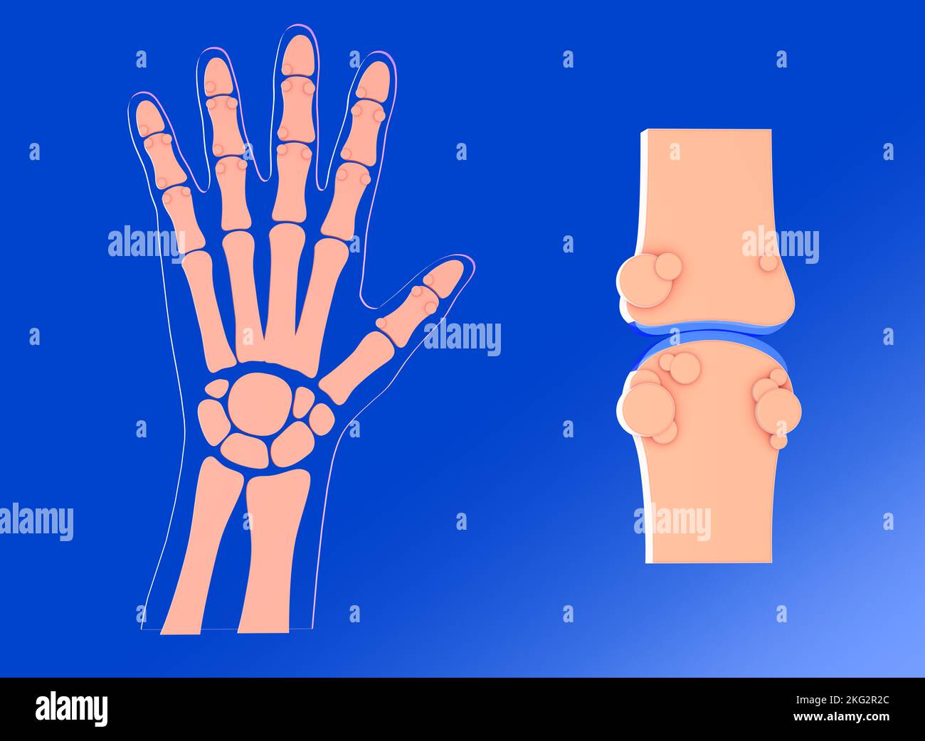 3D ilustración de la articulación sinovial con artrosis. Junto con la representación gráfica de la mano y sus huesos. Foto de stock