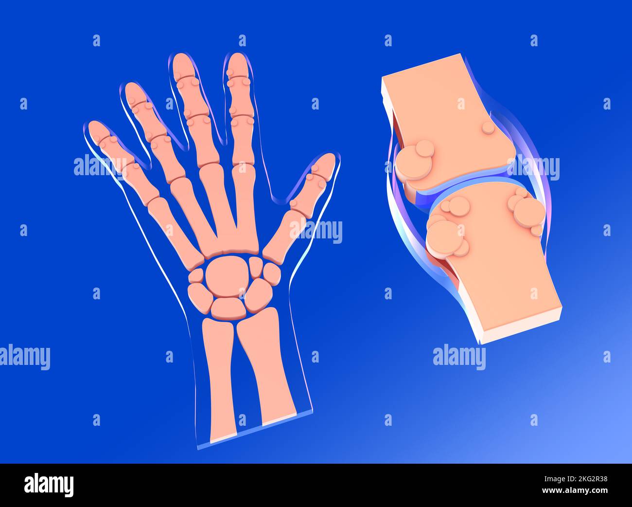 3D ilustración de la articulación sinovial con artrosis. Junto con la representación gráfica de la mano y sus huesos. Foto de stock