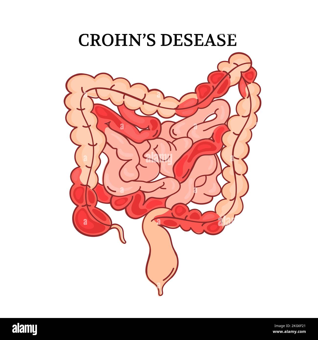 Enfermedad De Crohn Esquema De Medicina De Los Intestinos Anatomía Dibujado A Mano Por Vector 8180