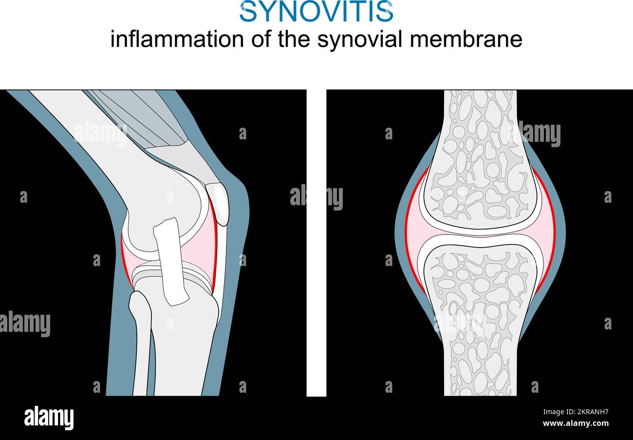 Tipos de sinovitis. Inflamación de la membrana sinovial de la rodilla y de la articulación sinovial. vector plano monocromo como ilustración de rayos x. Ilustración del Vector