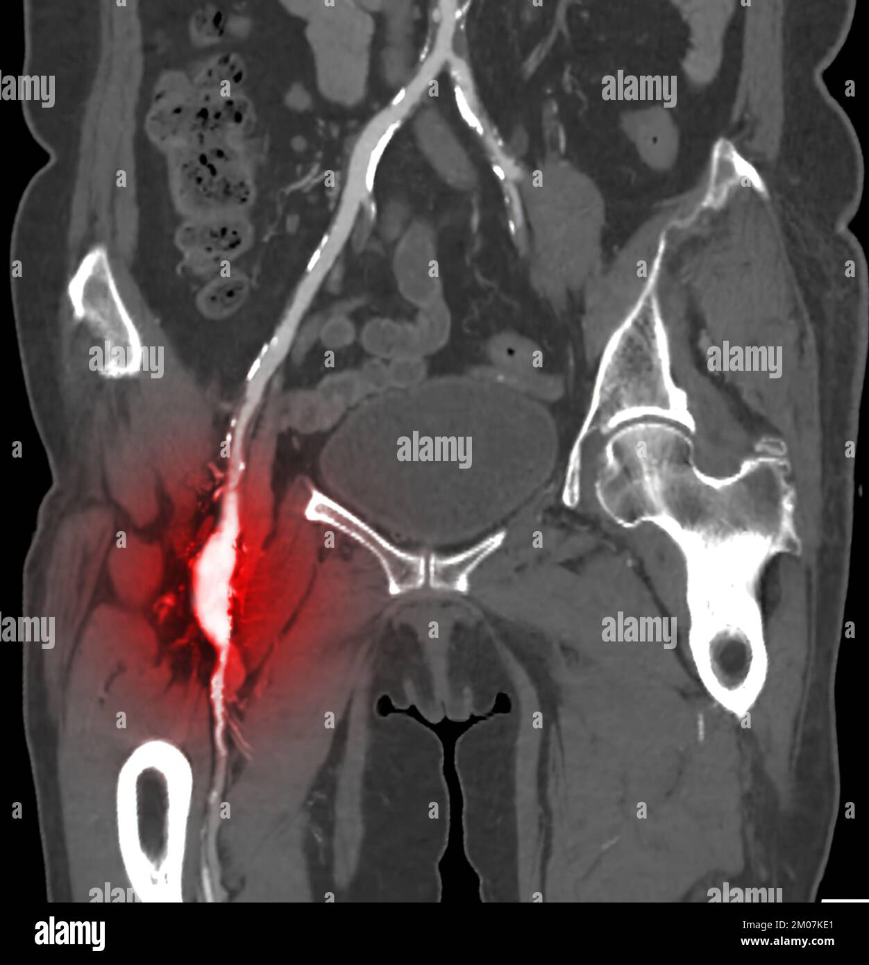 Cta Imagen De Desviación De La Arteria Femoral Para Diagnóstico De Arteriopatía Periférica Aguda 7008