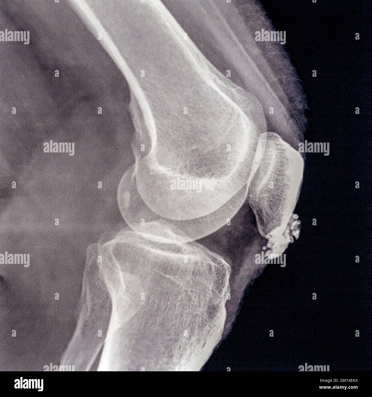 Mediados del siglo 20th Fotografía de rayos X / radiografía que muestra bursitis en la articulación de la rodilla, inflamación de una o más bursas de líquido sinovial en el cuerpo Foto de stock