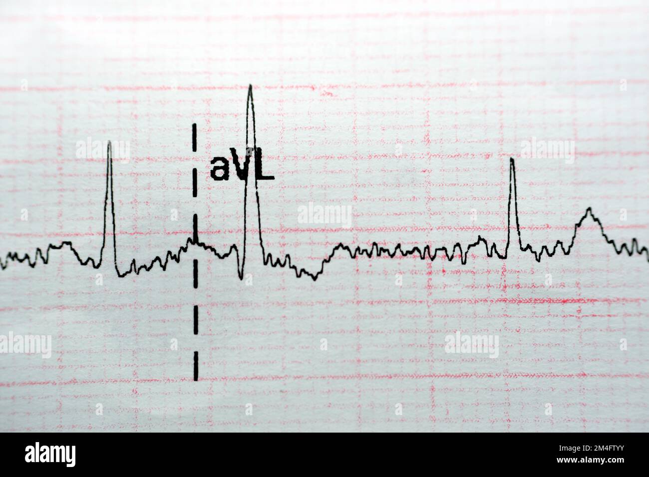 Papel del electrocardiógrafo de ECG que muestra la RSR del ritmo sinusal  normal con contracciones auriculares prematuras en PACS frecuentes, CVP  contracciones ventriculares prematuras Fotografía de stock - Alamy