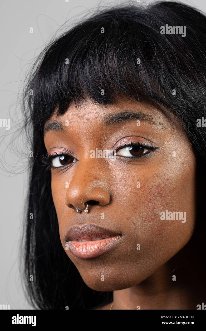 Rosacea black skin fotografías e imágenes de alta resolución - Alamy