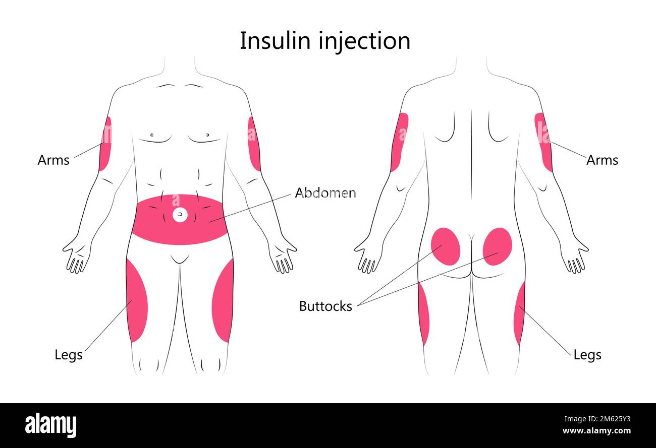 Vector infográfico de inyección de insulina. Tratamiento de la diabetes