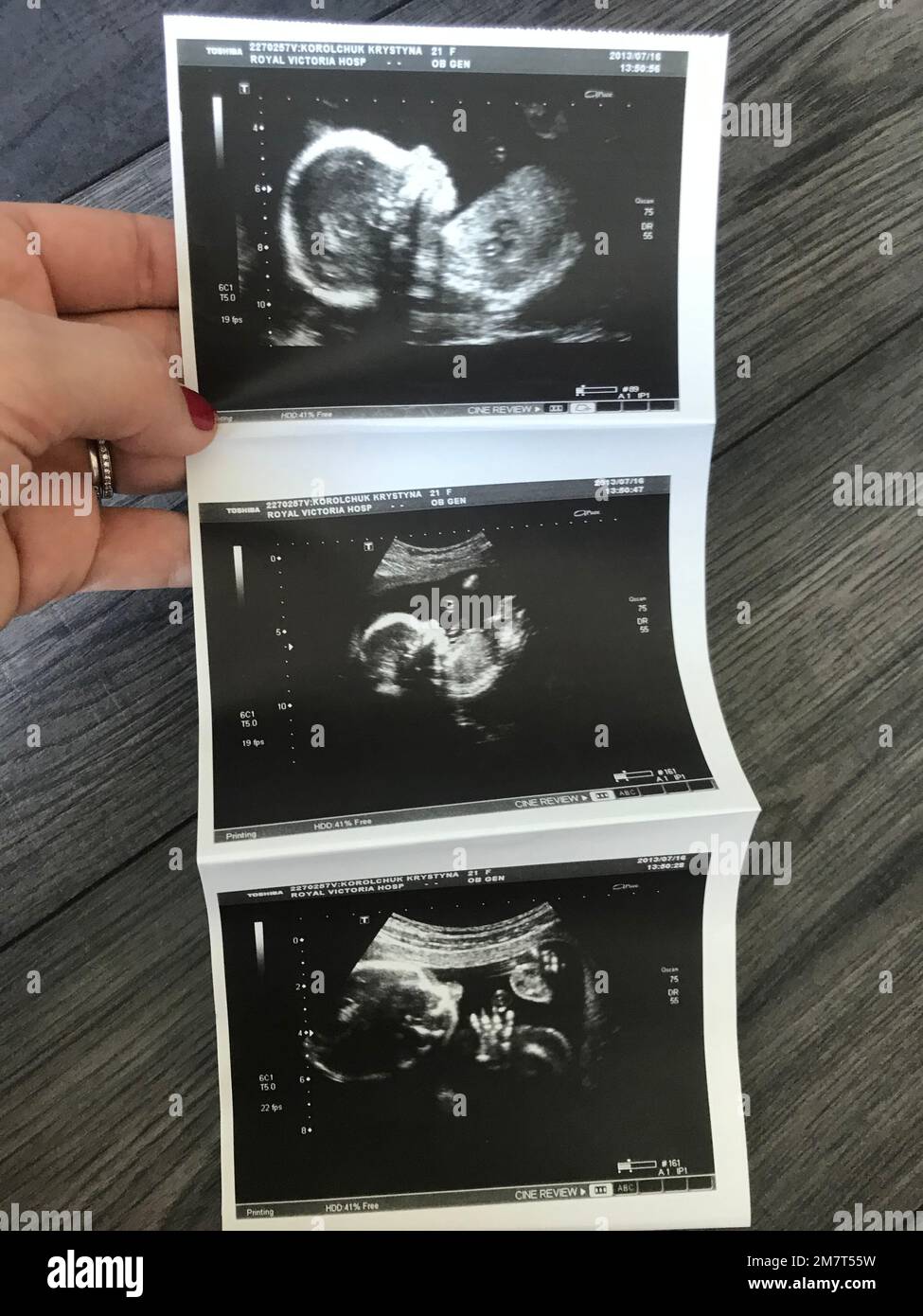 Radiografía de un bebé Fotografía de stock - Alamy