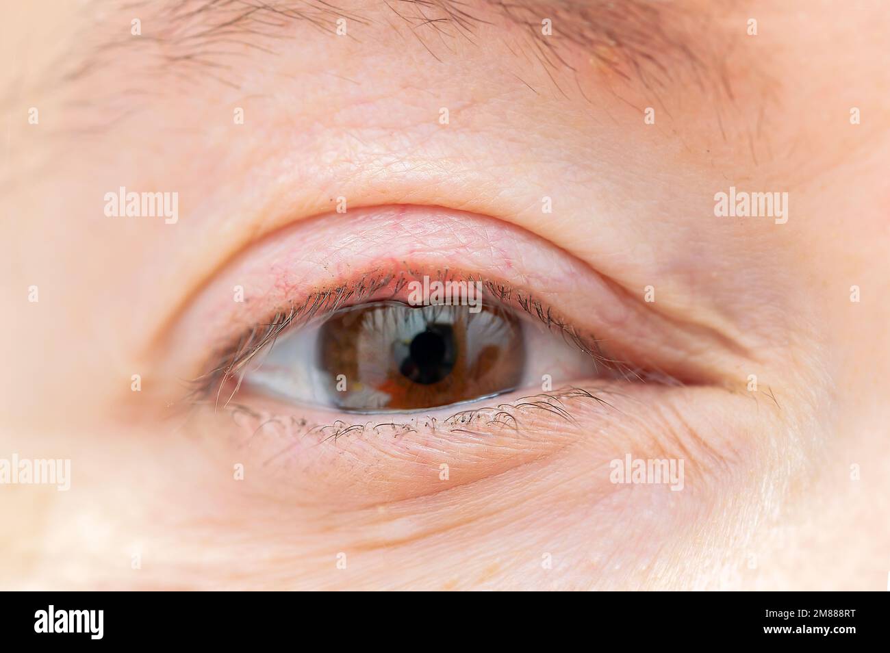 Cerca del ojo de una mujer con una infección bacteriana de una glándula sebácea en el párpado inferior. Foto de stock