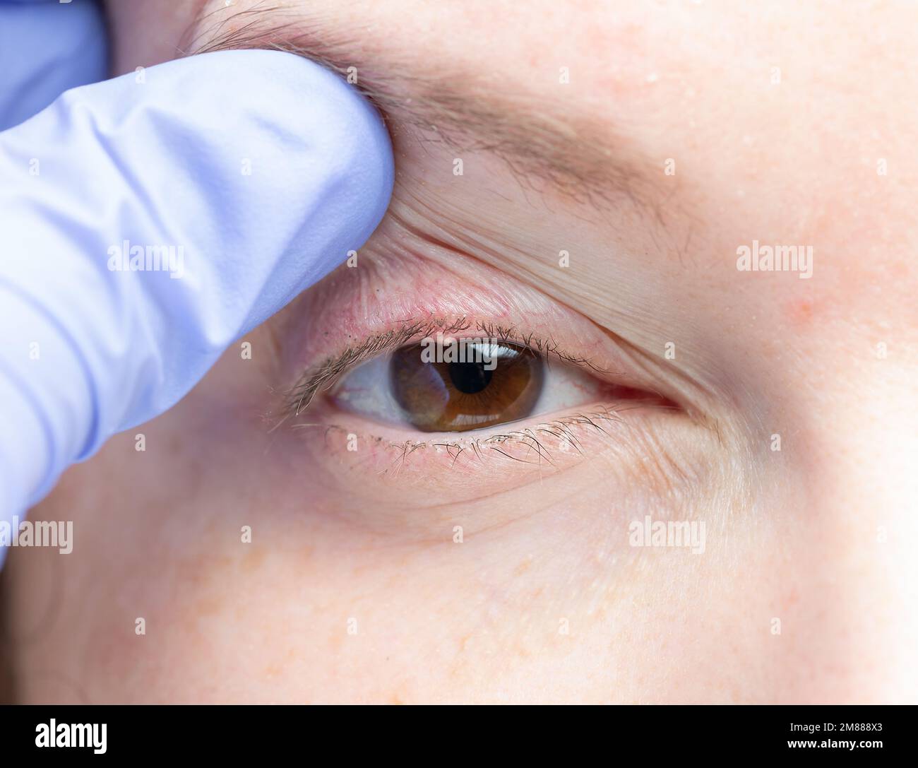 cerca del ojo de una mujer con una infección bacteriana de una glándula sebácea en el párpado inferior. Foto de stock