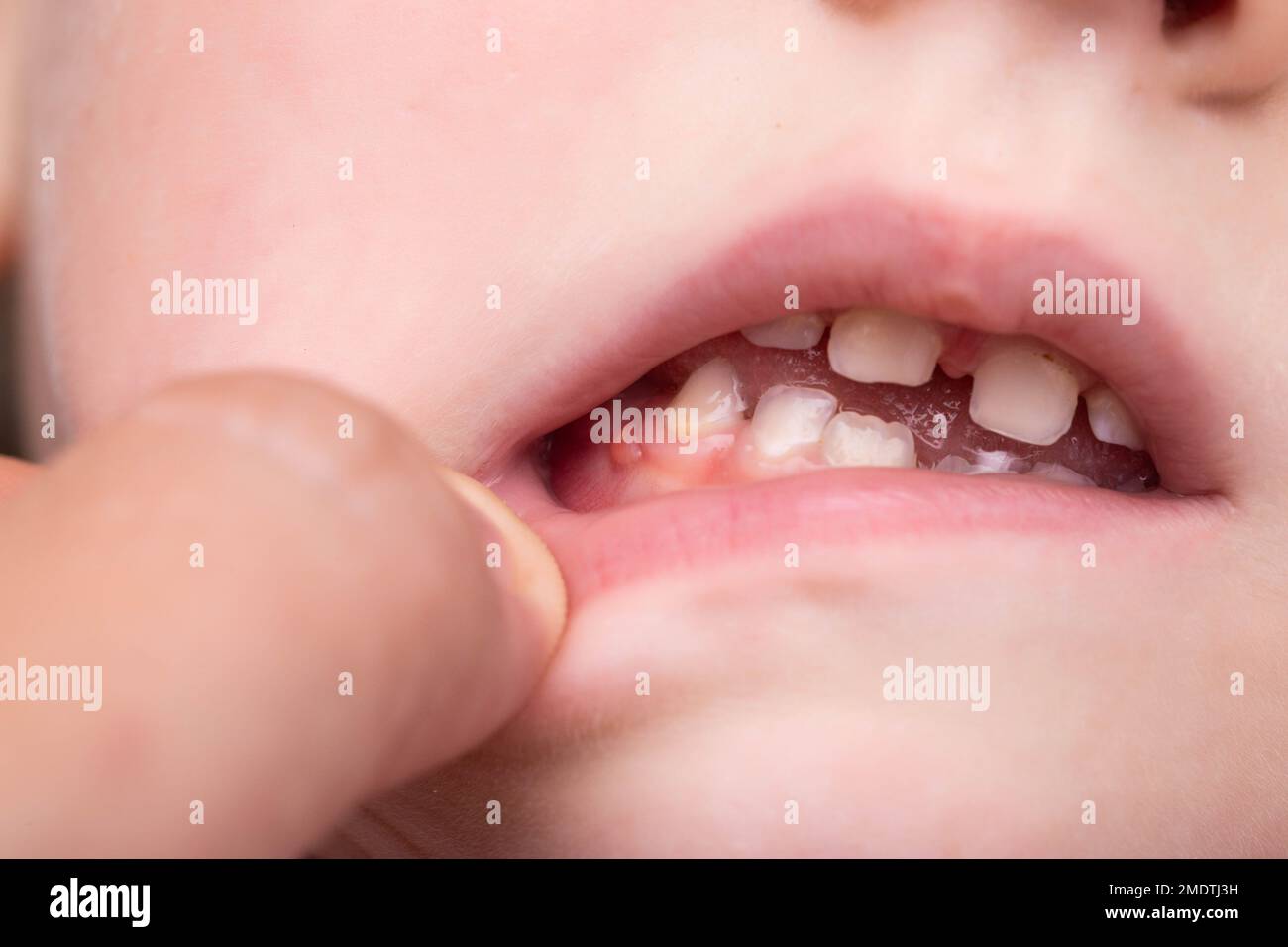 Tumor en la boca fotografías e imágenes de alta resolución - Alamy