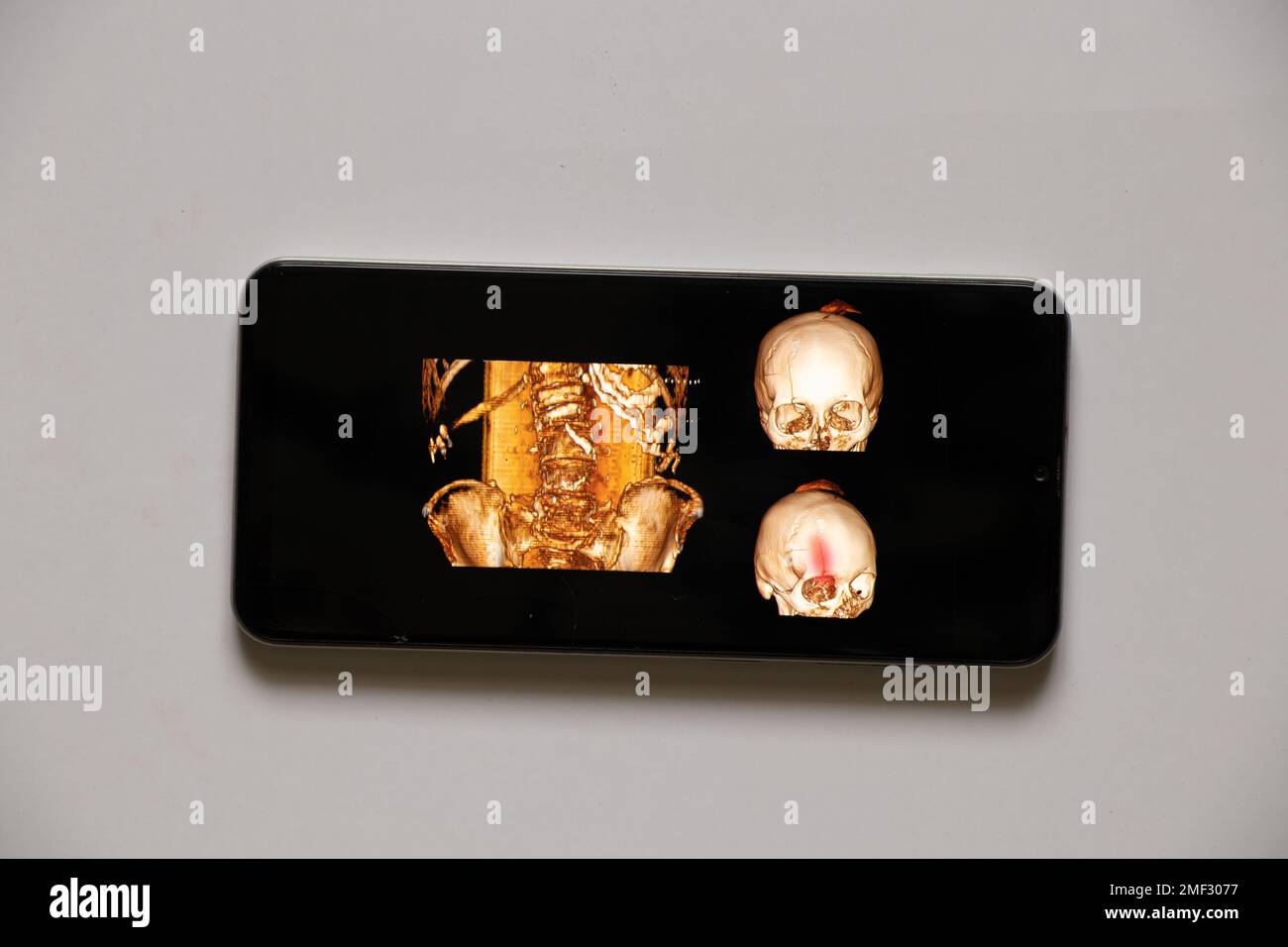 tomografía computada de la columna vertebral de un anciano con osteochandrosis con vértebras fracturadas y su desplazamiento y un cráneo con fractura por fractura Foto de stock