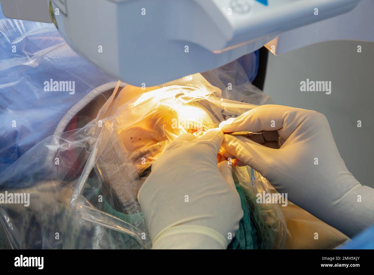 Corrección de la visión con láser. Paciente y equipo de en el quirófano la cirugía Espéculo del párpado. LASIK. Paciente inferior Fotografía de stock - Alamy