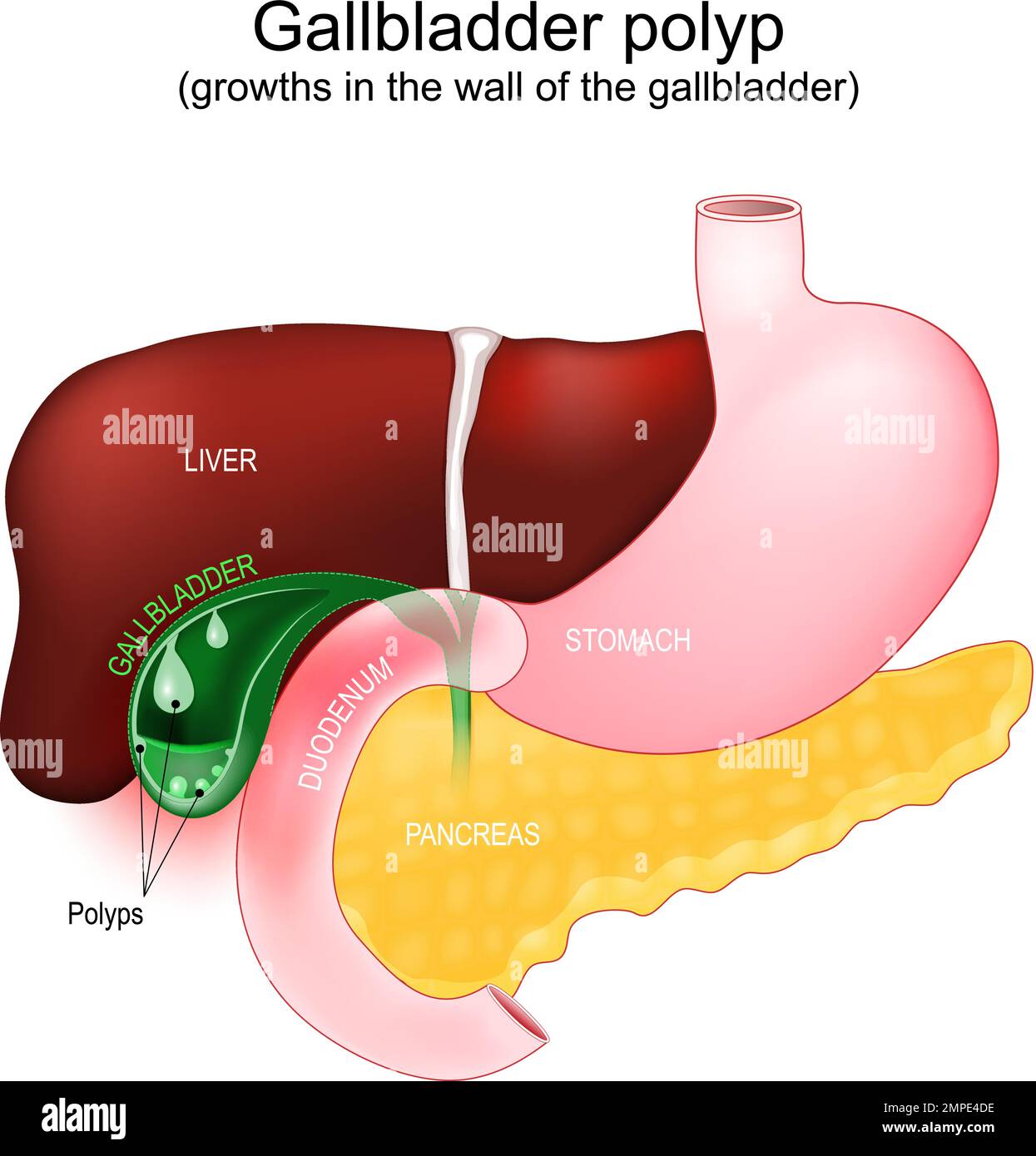 Sección transversal de una vesícula biliar con pólipos. Acumulaciones anormales de tejido de la membrana mucosa, crecimientos en la pared de la vesícula biliar. Parte de un humano Ilustración del Vector