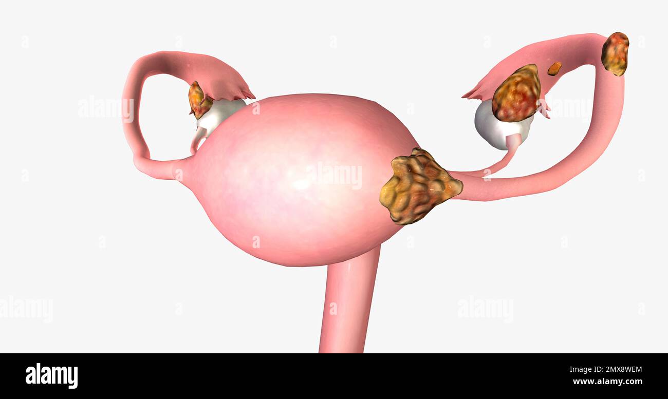 El tumor ovárico en estadio II se diseminó a órganos cercanos, como el  útero y el cuerpo de las trompas de Falopio. Renderizado 3D Fotografía de  stock - Alamy