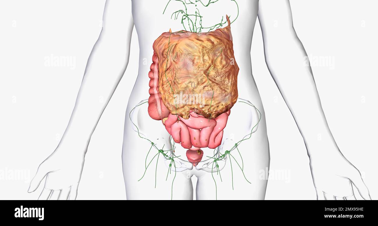 El cáncer de ovario en estadio III se ha diseminado más allá del área