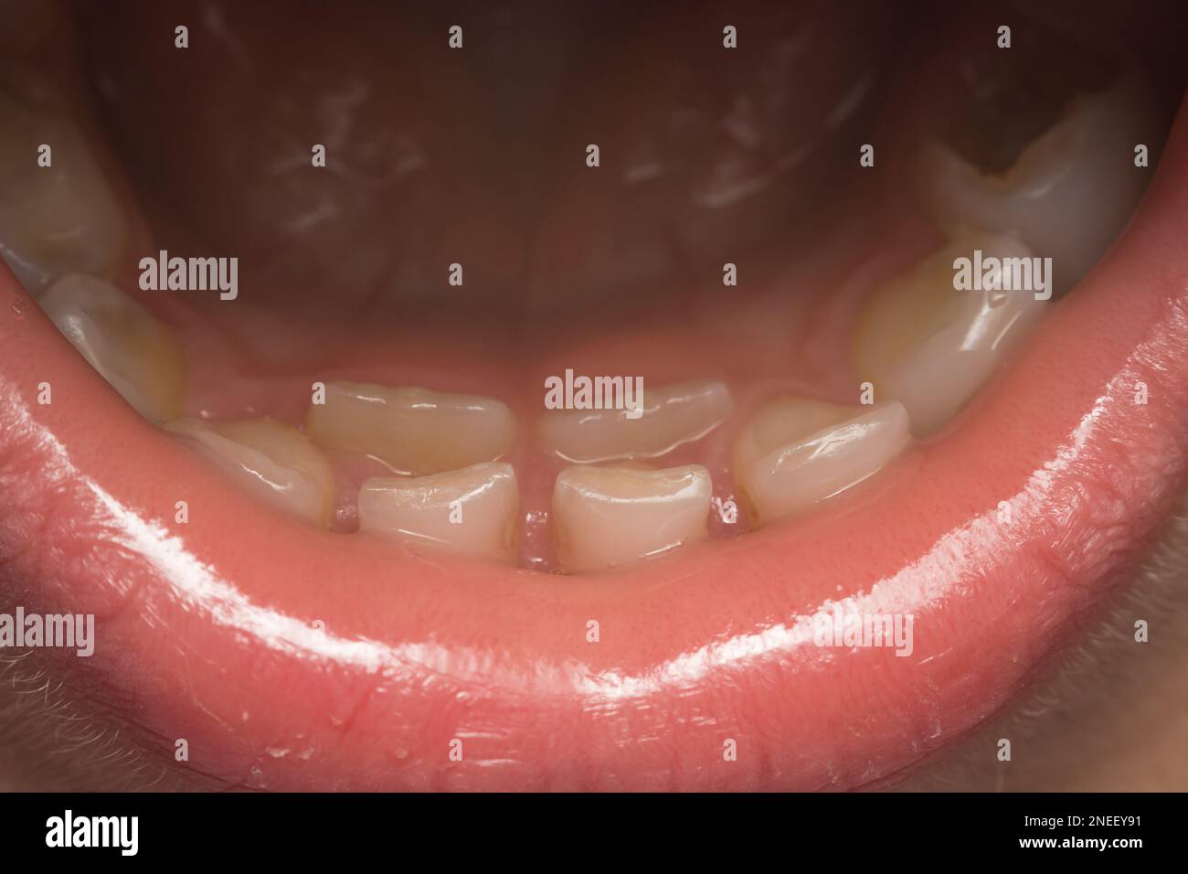 boca infantil antes de la extracción de dientes deciduos Fotografía de  stock - Alamy