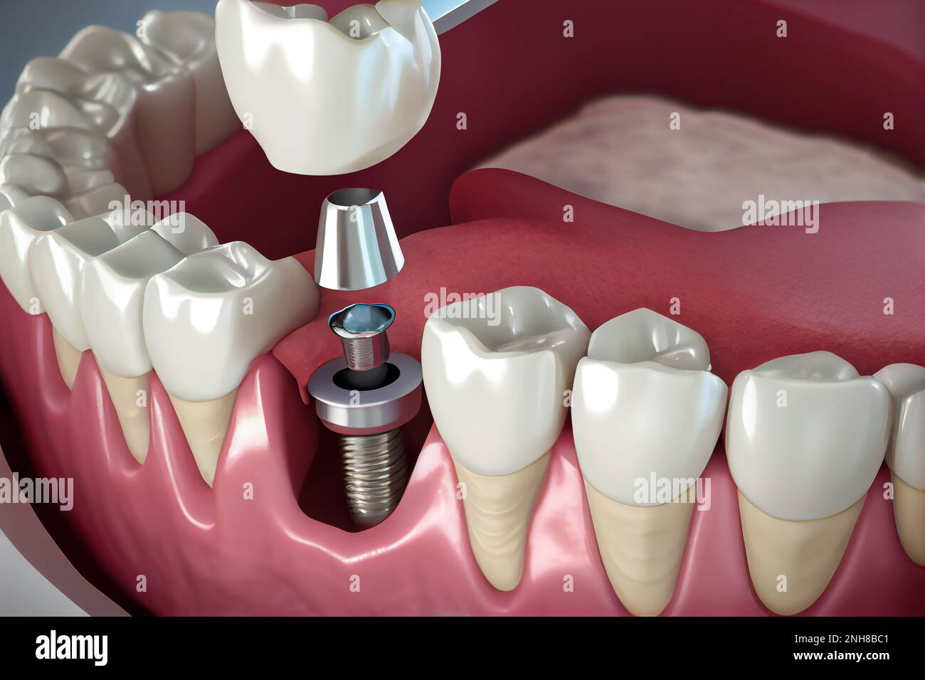 Instalación diente de implante, tornillo de metal y diente de corona blanca  de una ilustración de cuidado dental AI generativa Fotografía de stock -  Alamy