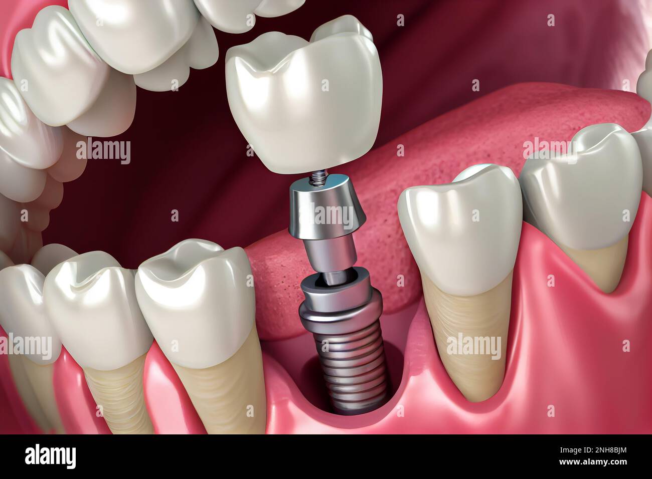Instalación diente de implante, tornillo de metal y diente de corona