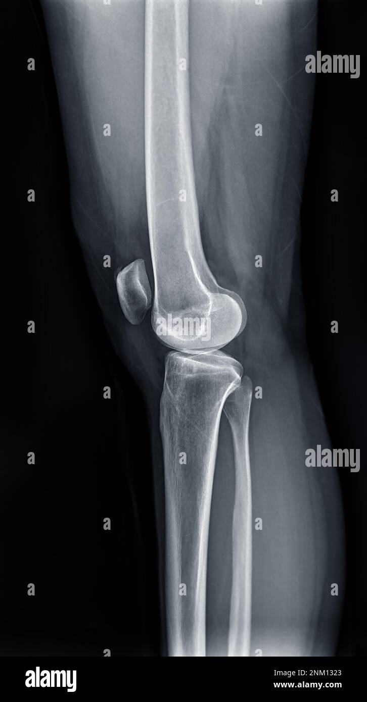 Radiografía de película de la articulación de la rodilla izquierda