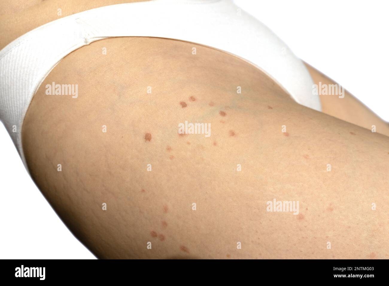 quemaduras por depilación láser. Manchas de quemaduras del tratamiento  cutáneo con láser para la depilación corporal. quemaduras. Foto de alta  calidad Fotografía de stock - Alamy