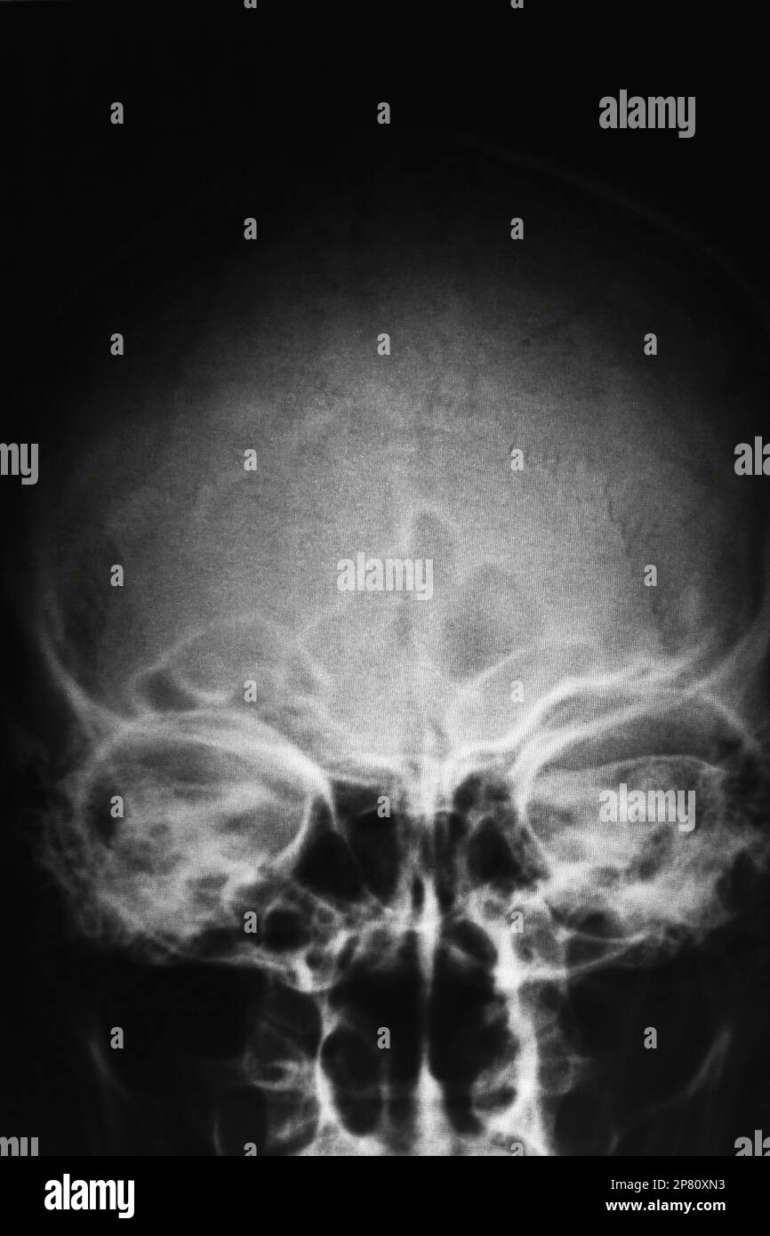 Radiografía frontal de cráneo humano Fotografía de stock Alamy