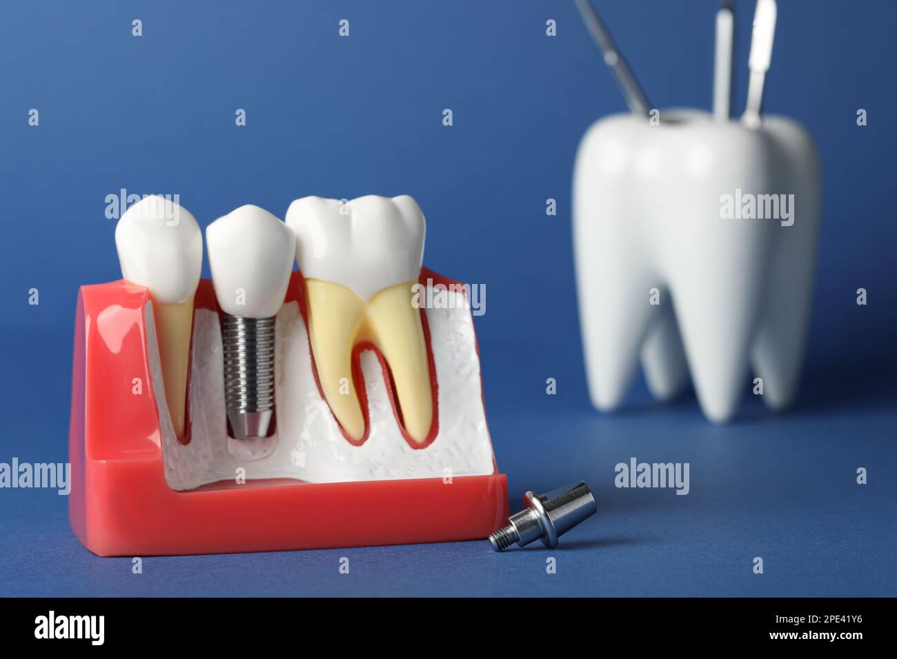 Modelo educativo de goma con implante dental entre dientes sobre fondo  azul. Espacio para texto Fotografía de stock - Alamy