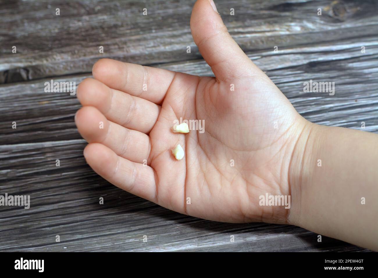 Los dientes temporales primarios caducifolios del bebé, el primer conjunto de dientes en el crecimiento y desarrollo de los seres humanos, generalmente se pierden y se reemplazan por permanentes Foto de stock