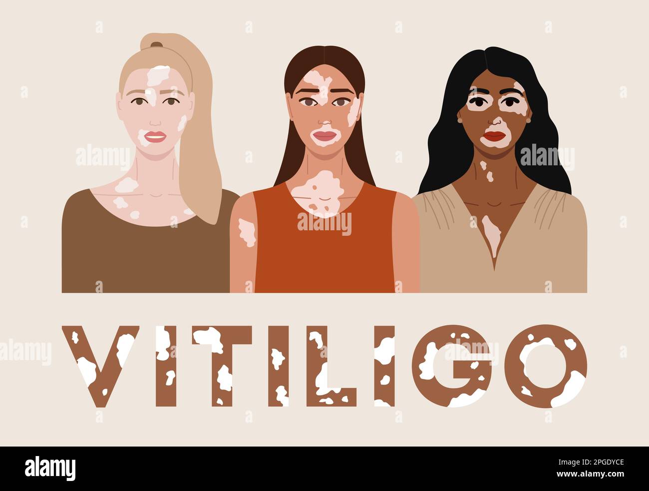 Conjunto de caras femeninas con vitiligo. Cartel del Día Mundial del