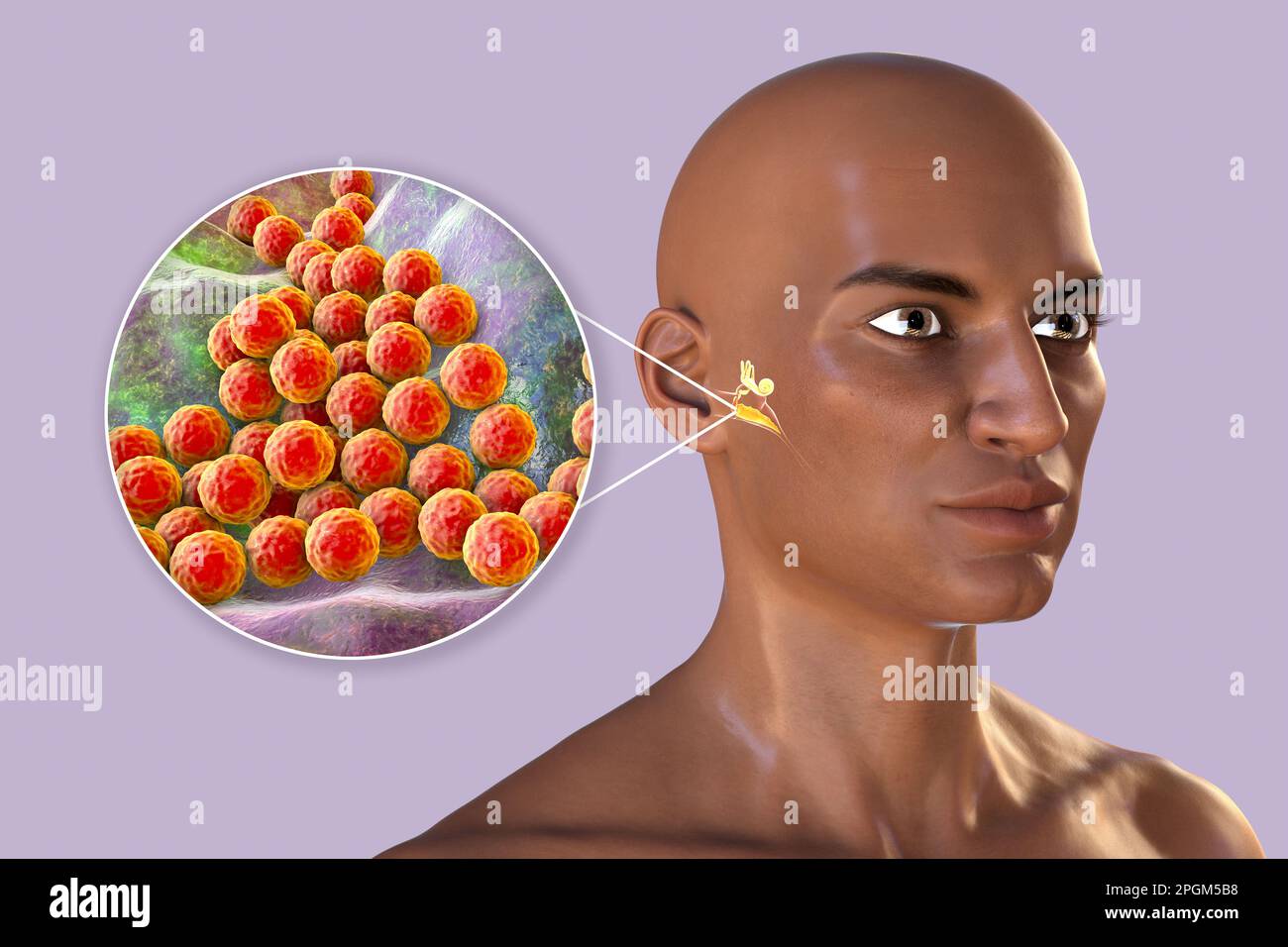 Otitis media infección del oído causada por la bacteria Staphylococcus aureus, ilustración