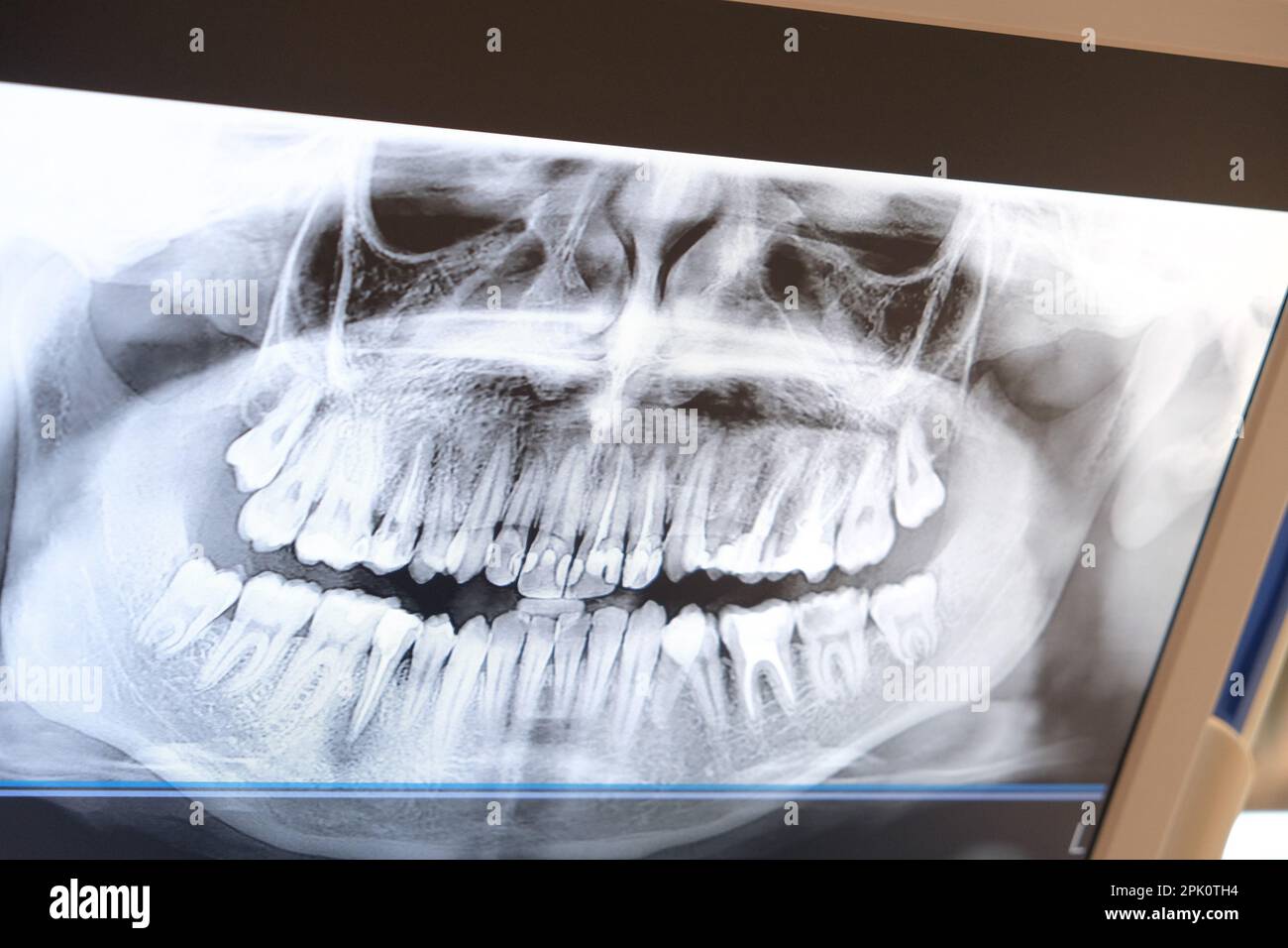 Cierre la radiografía del diente en la pantalla digital de la clínica