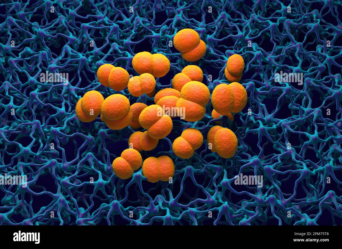 Neisseria meningitidis (meningococo) bacterias en el cerebro (infección