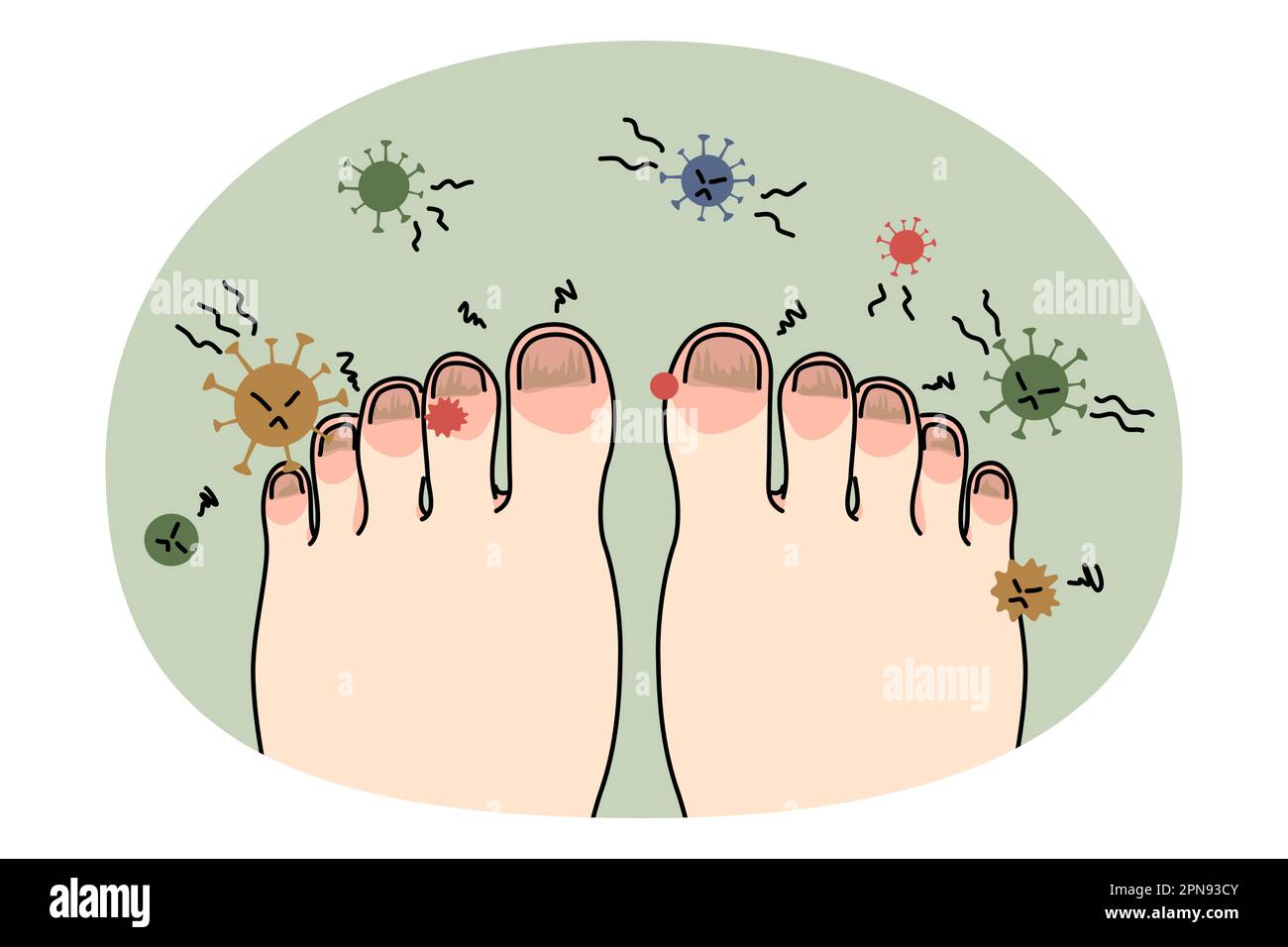 Pies de la persona con enfermedad o infección de las uñas. Pie con