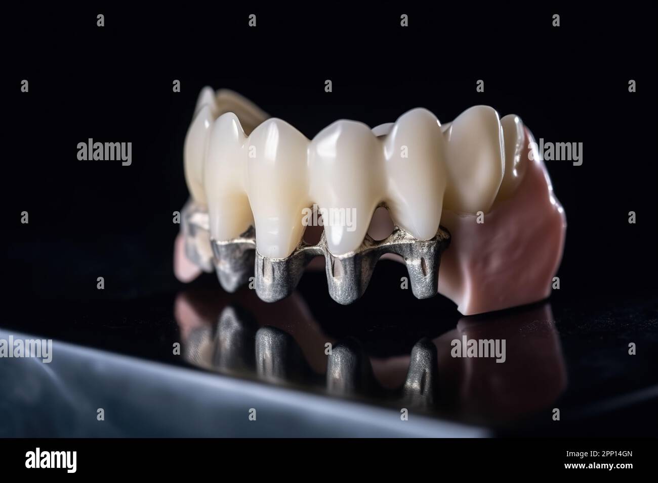 Concepto para prótesis dental. demostración de la colocación de un