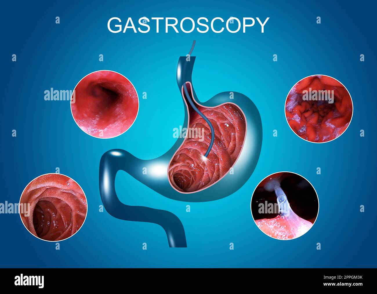 Endoscopia Digestiva O Gastroscopía. Realizar Un Procedimiento De ...