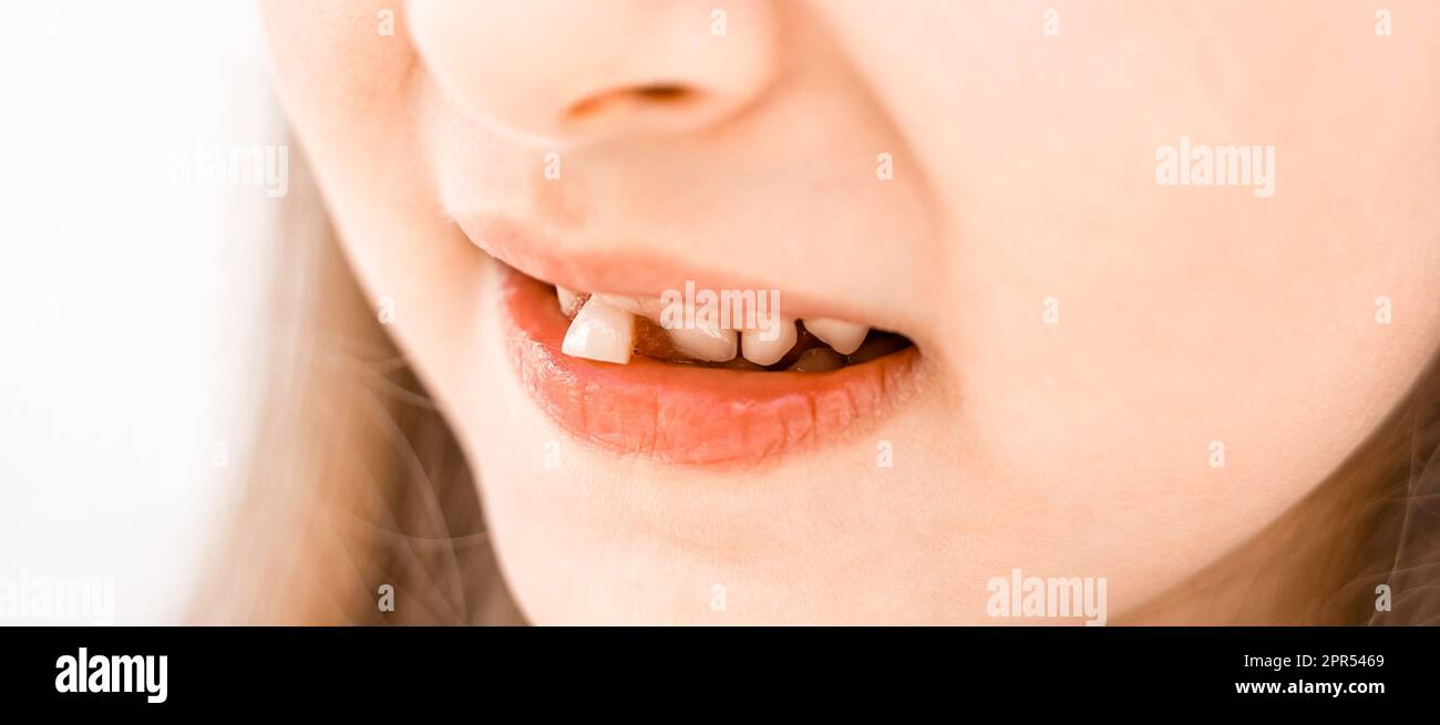 Niño sonriente encantador de la niña con la boca abierta muestra tambaleante suelta cayendo hacia fuera primer diente delantero de la leche del bebé. Dientes preescolares cambiando. Saludable Foto de stock