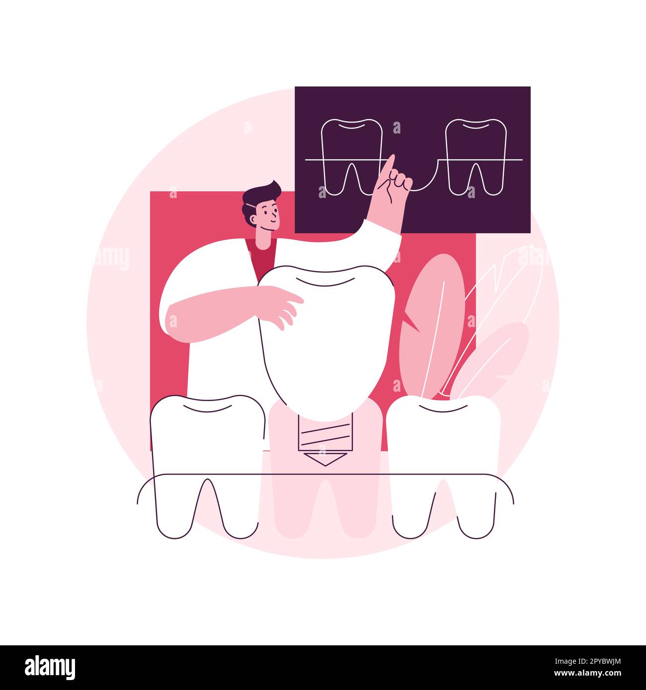 Dentaduras dentales implantes concepto abstracto ilustración vectorial.  Implante de dentadura, blanqueamiento dental, reemplazo permanente de  dientes, odontología cosmética, metáfora abstracta del procedimiento de  cuidado ortodóntico Imagen Vector de ...