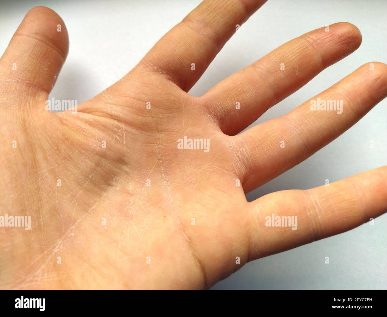 Mano femenina con piel atópica seca. Fondo blanco. Primer plano de la piel  en la palma de la mano y los dedos. Derma en necesidad de cuidado e  hidratación. Arrugas, sequedad e