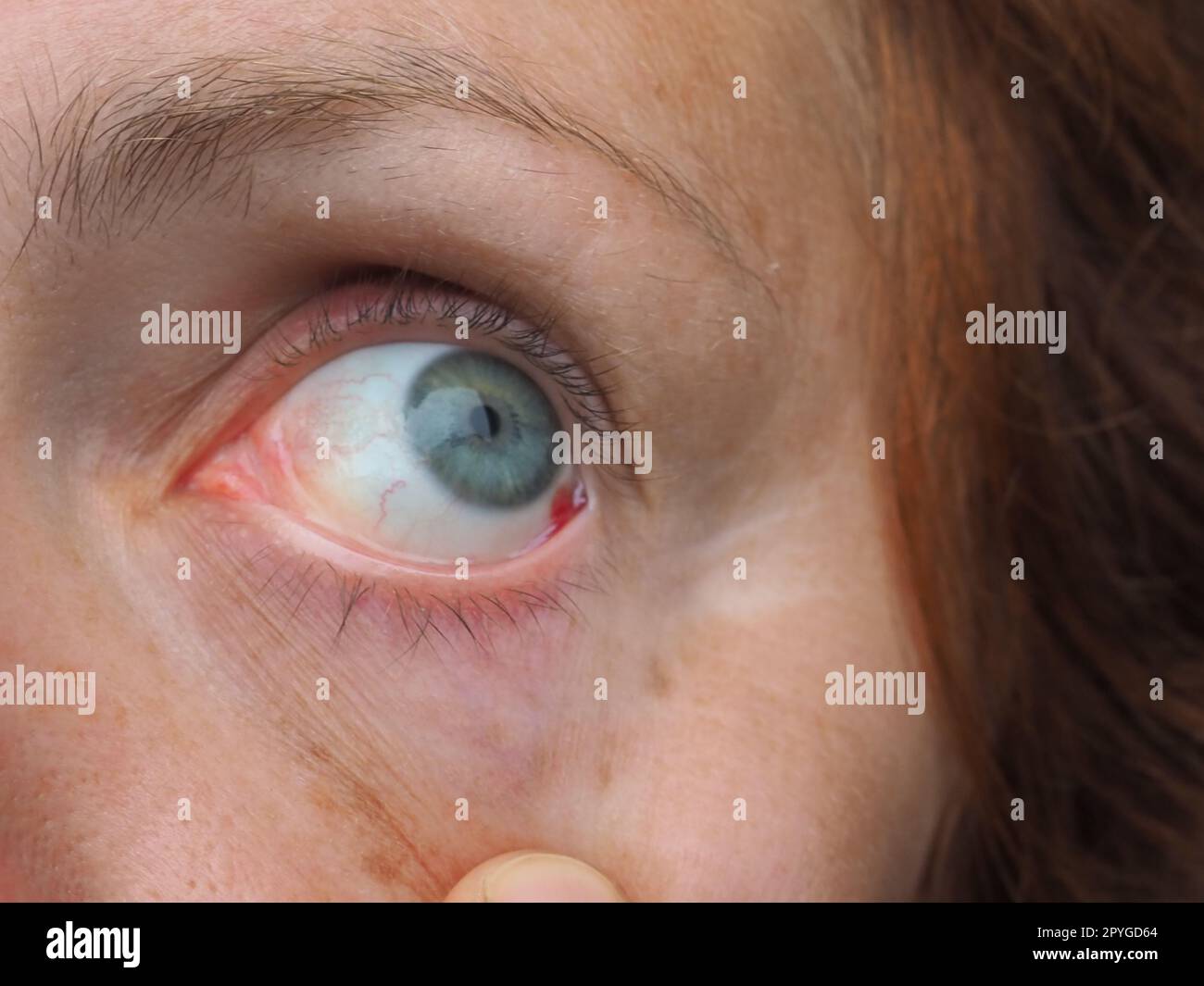 Hemorragia subconjuntival o hemorragia subconjuntival, hiposhagmus