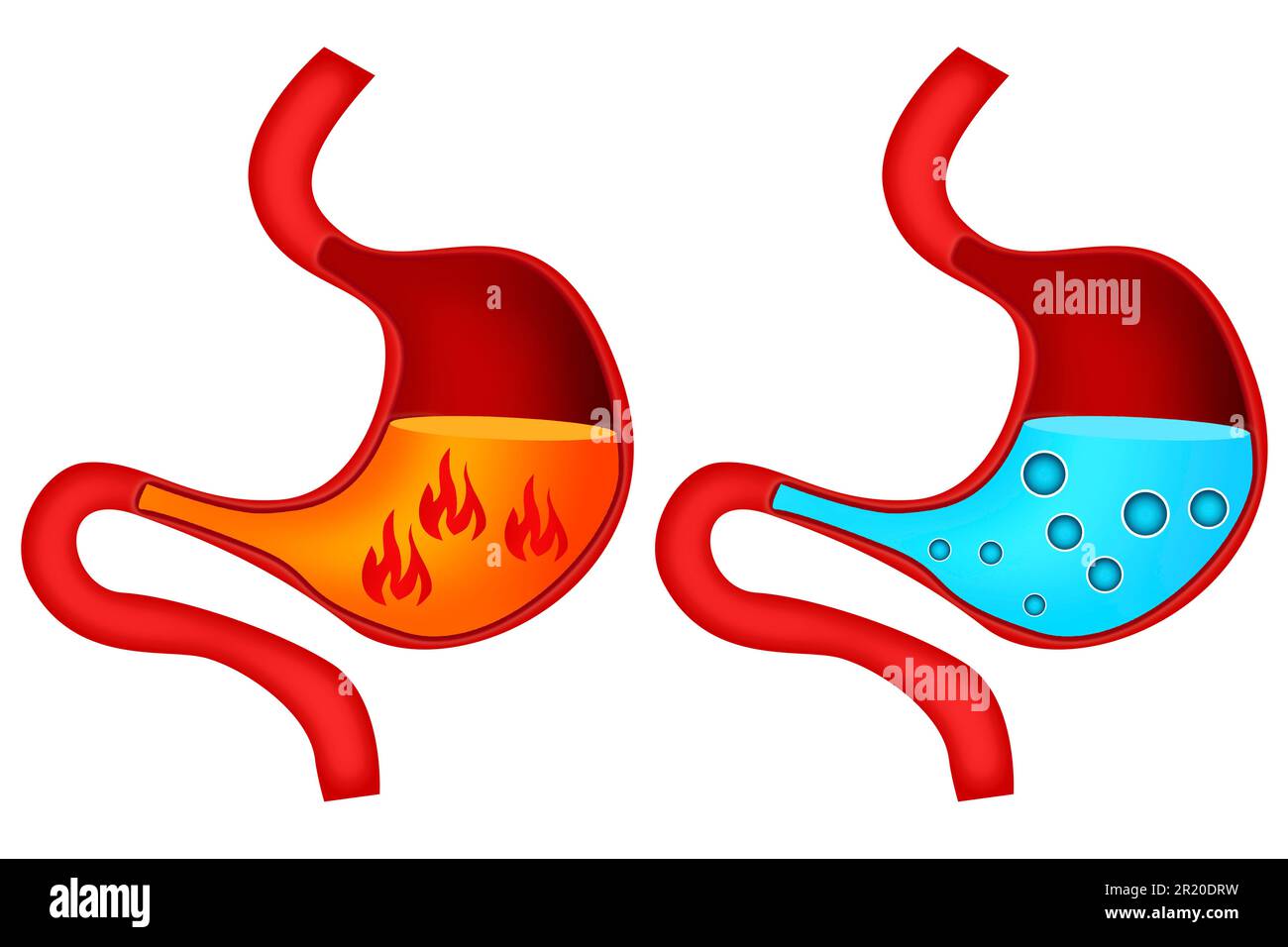 Acidez estomacal y gastritis en el estómago, representación 3D