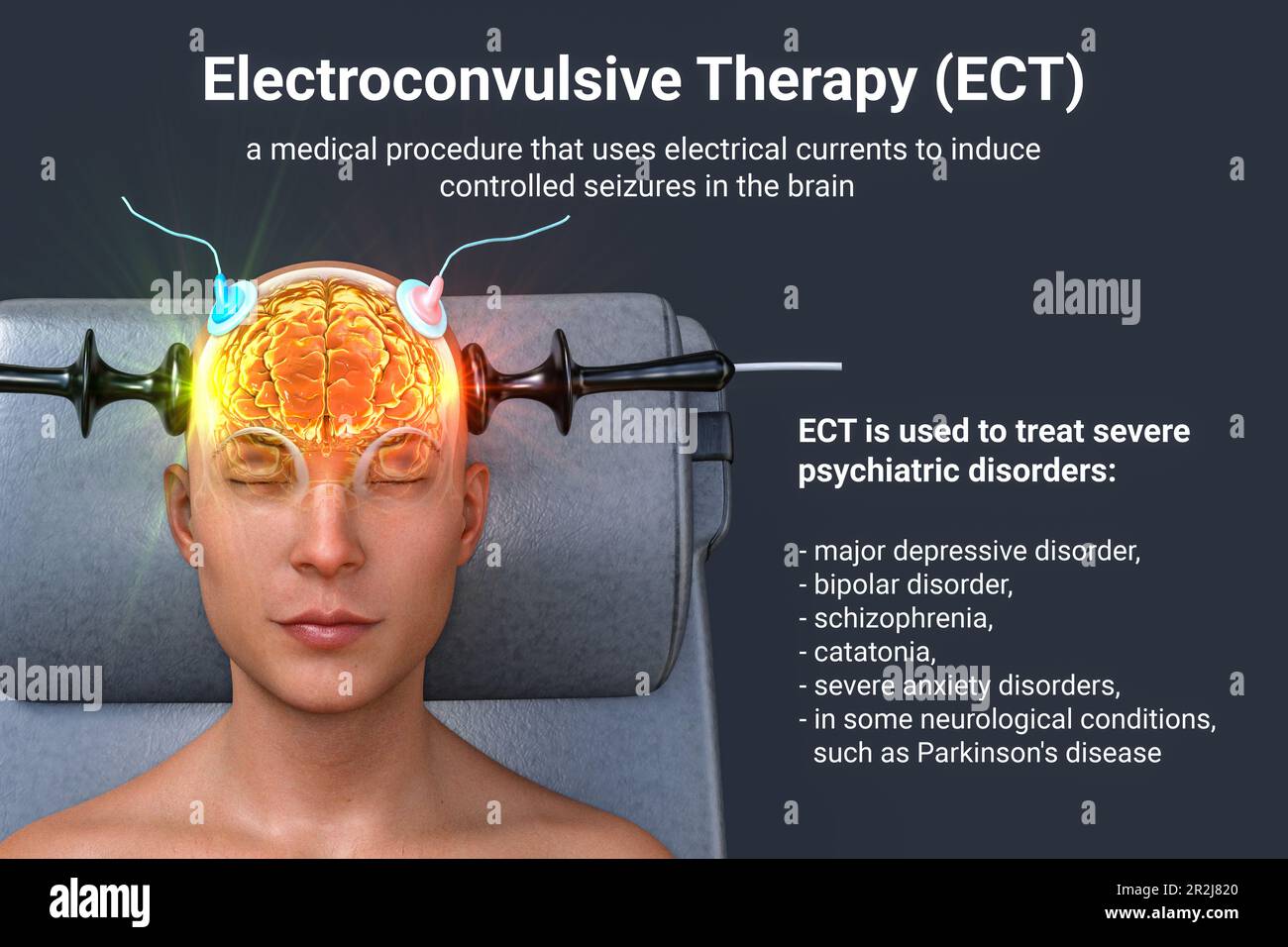Terapia electroconvulsiva, ilustración Fotografía de stock Alamy