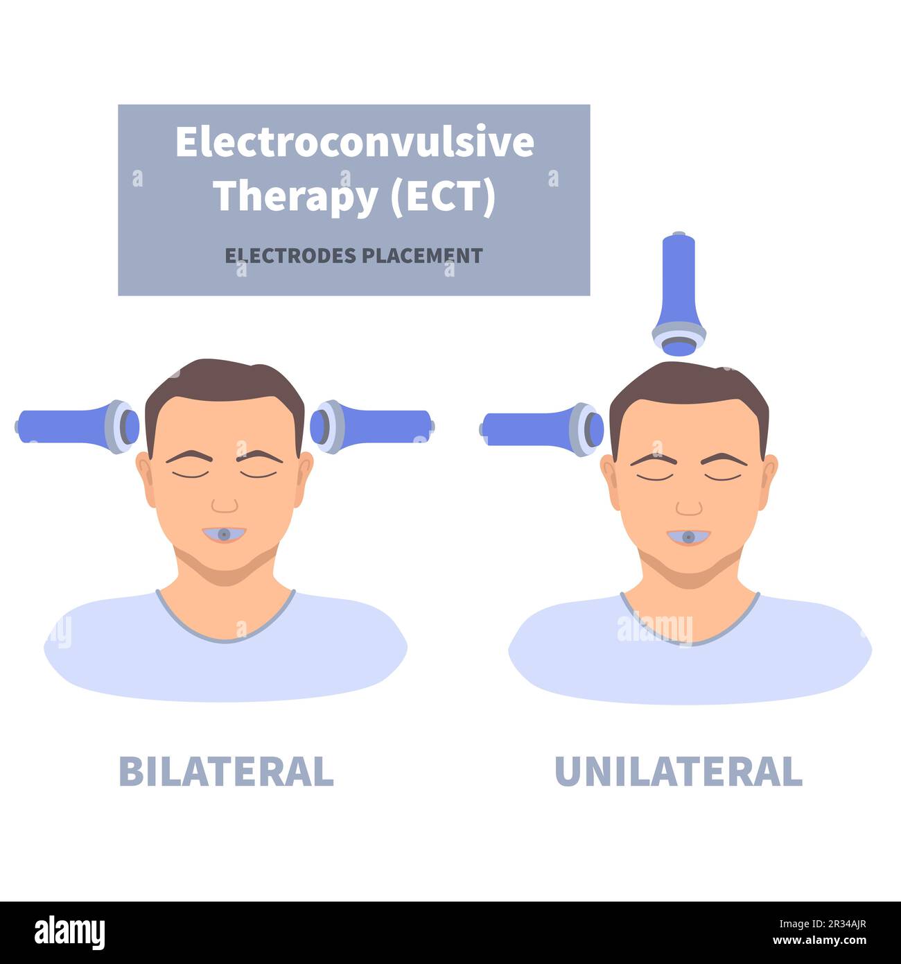Terapia electroconvulsiva ECT para el tratamiento de la depresión severa Imagen Vector de stock Terapia electroconvulsiva ECT para el tratamiento de la depresión severa Imagen Vector de stock